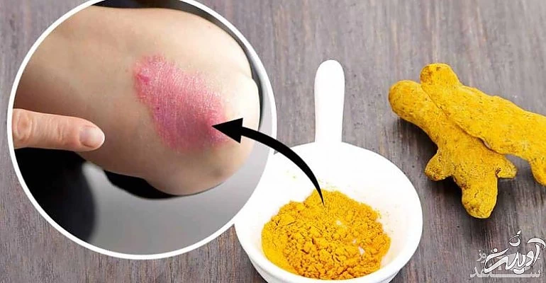 زردچوبه برای زخم